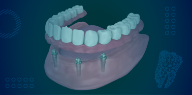 Implant Supported Overdenture, removable (with 3 implants) **